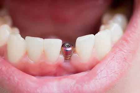 dentist performing dental implant surgery 