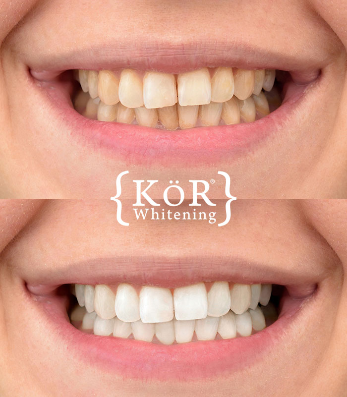 Closeup of smile before and after teeth whitening