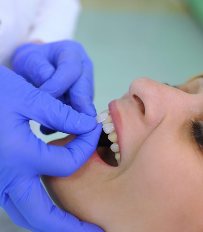 Dentist comparing cosmetic dental bonding shade to dental patient's smile