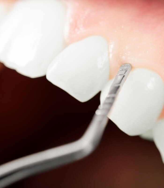 Closeup of smile during gum recontouring treatment