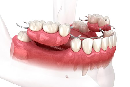 Full and partial dentures arranged against neutral background