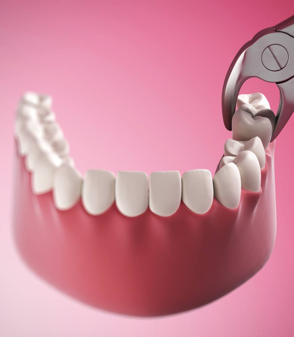 Illustration of dental forceps gripping molar