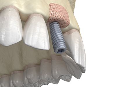 Digital illustration of bone graft