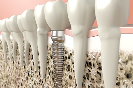 Digital illustration of dental implant