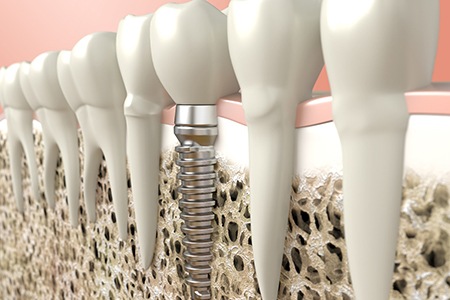 Digital illustration of dental implant