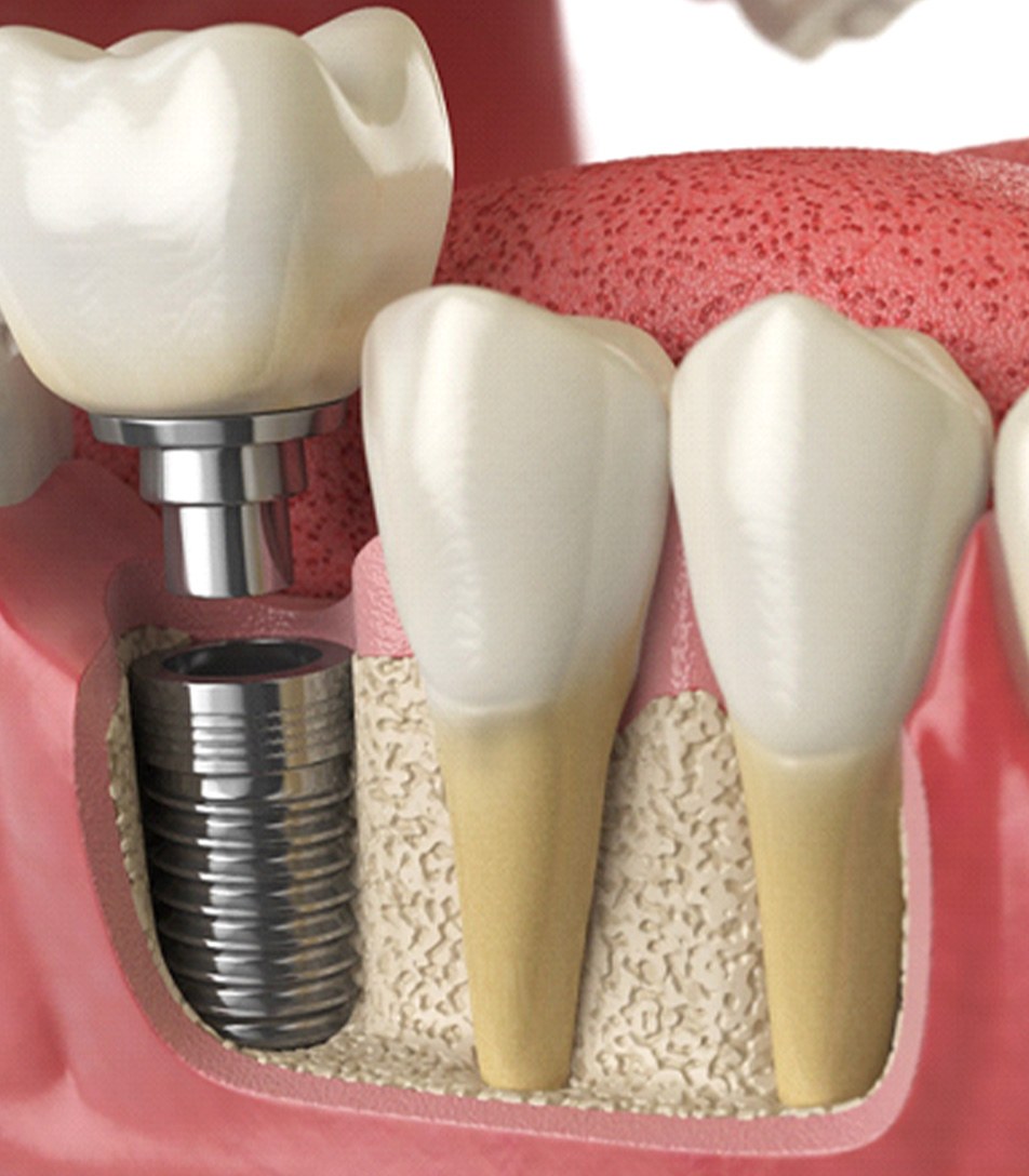 3D render of a dental implant