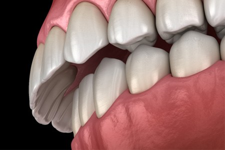 A 3D illustration of a dental implant abutment