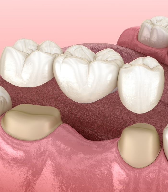 Animated smile during dental bridge placement to replace missing teeth