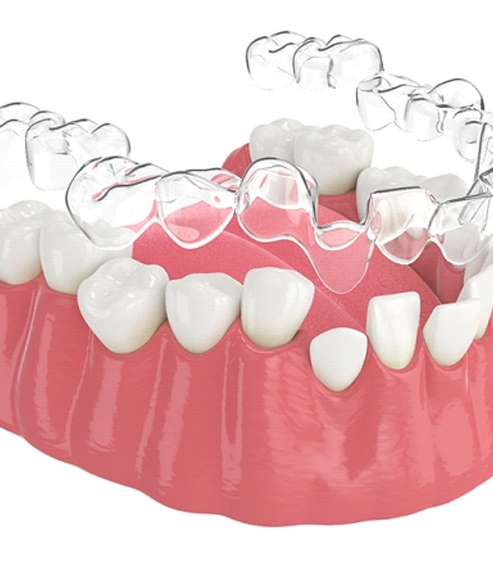 Illustration of clear aligner being placed on misaligned teeth