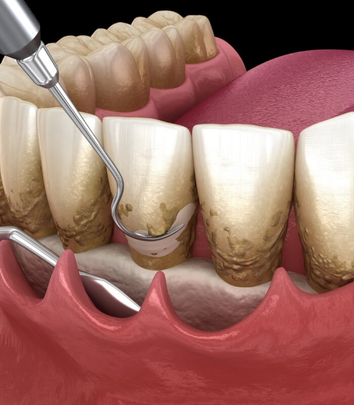 Animated smile during scaling and root planing treatment