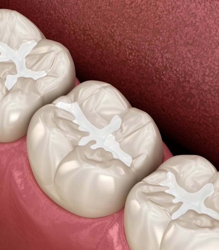 Animated smile with tooth colored fillings