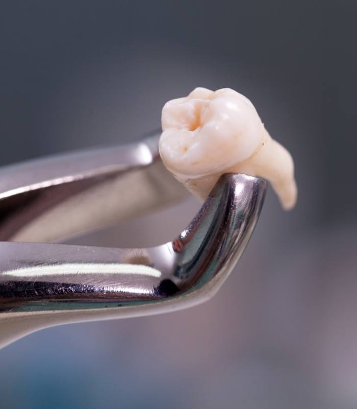 Metal clasp holding tooth after extraction