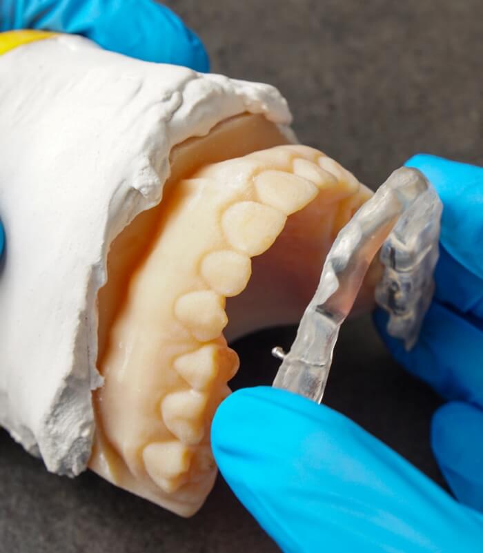 Model smile fitted with occlusal splints