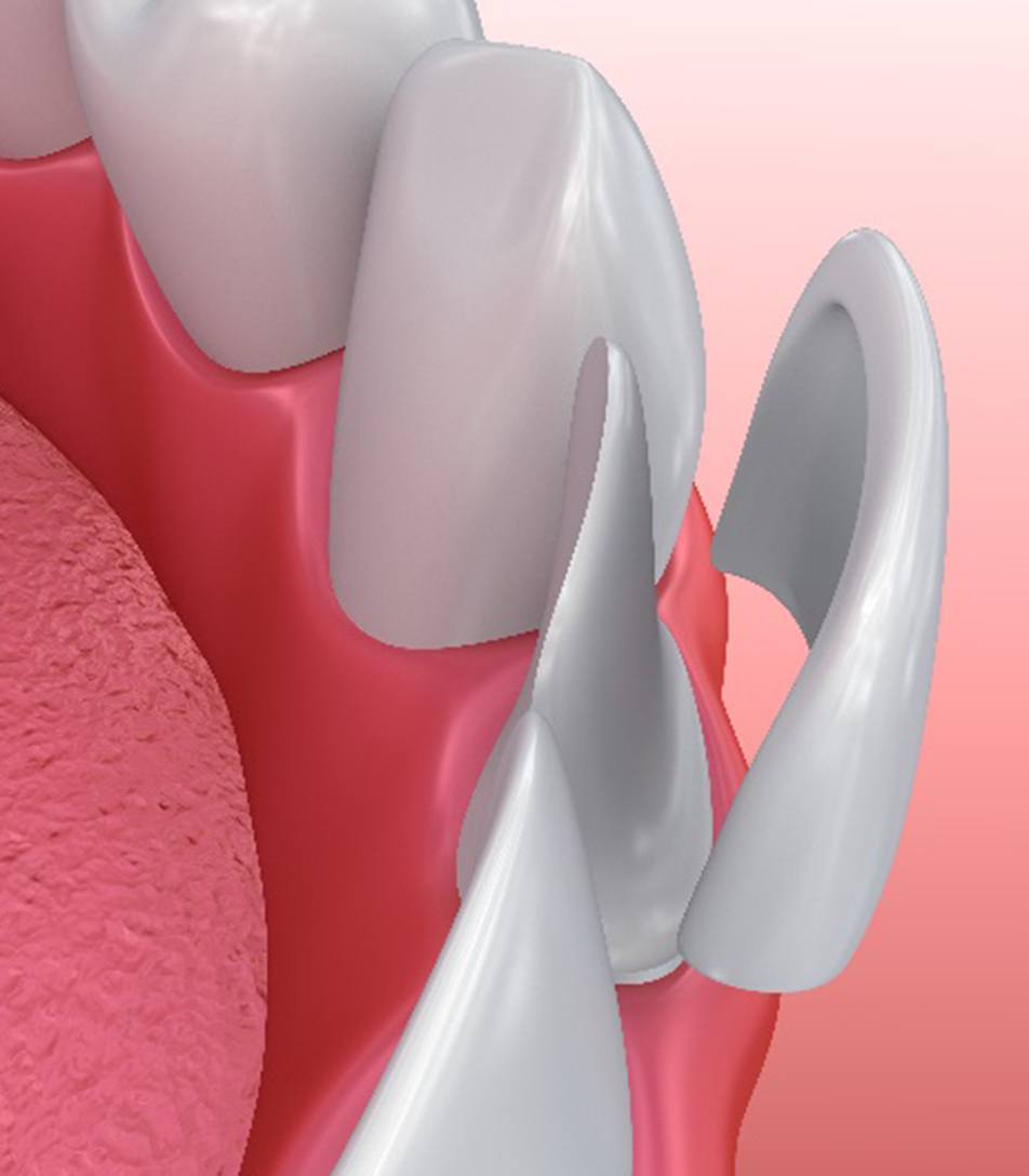 Illustration of veneer being placed on bottom, front tooth