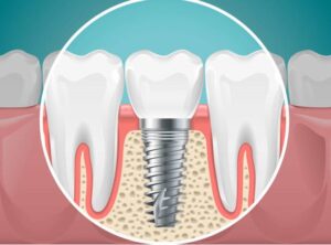 Model of a dental implant replacing a missing tooth